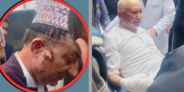 आगोको ज्वालाले घाइते उपप्रधानमन्त्री पौडेल र मेयर आचार्यको कीर्तिपुर बर्न अस्पतालमा उपचार जारी